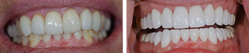 Dental Crowns- Before & After