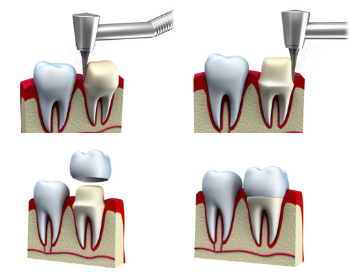 Dental Crowns