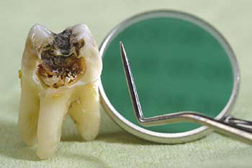 Damaged Tooth Extractions