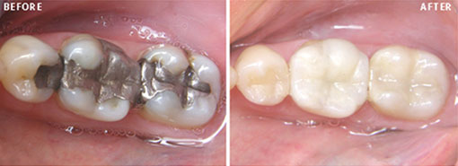 White Fillings- Before & After