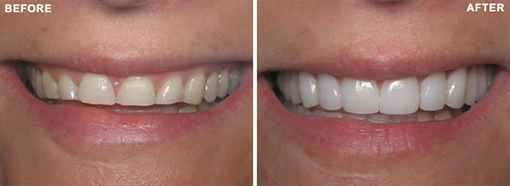 Porcelain Veneers- Before & After