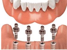 Implant-Supported Dentures