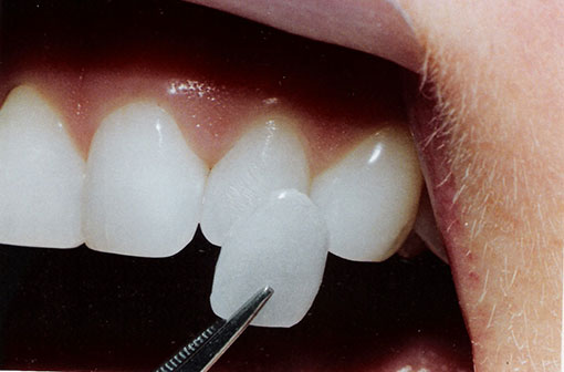 Porcelain Veneers