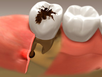 Infected Tooth