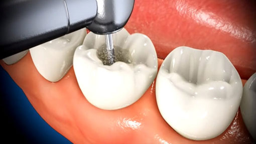 Root Canal Cleaning