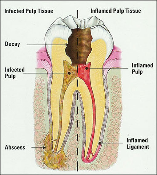 Infected Tooth Root