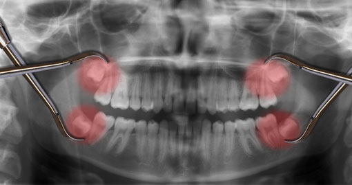 Wisdom Tooth Extractions