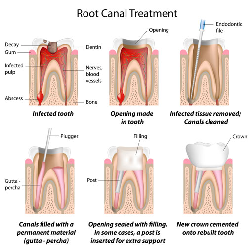 Endodontic Treatment